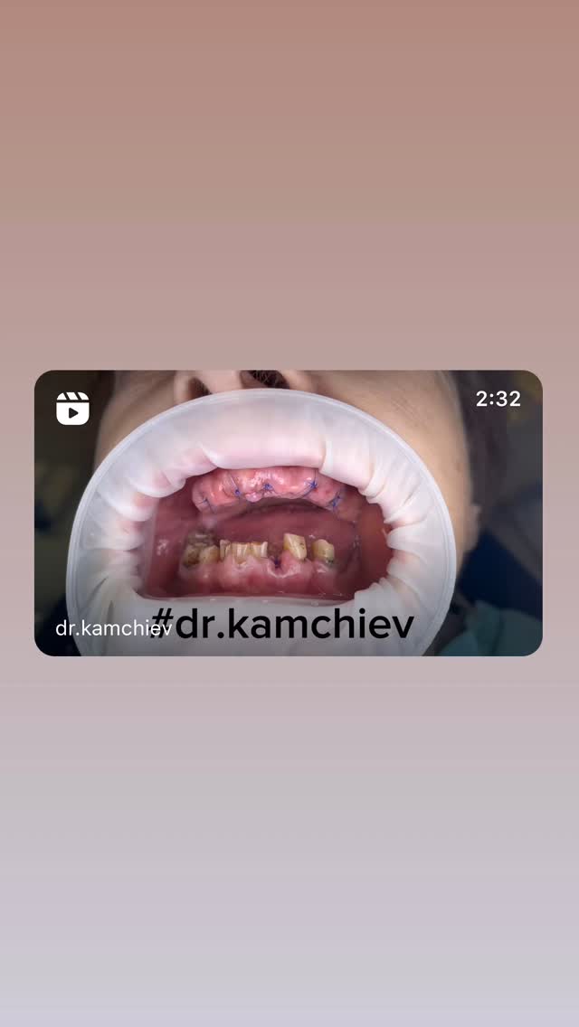 Комбинированное восстановление зубов