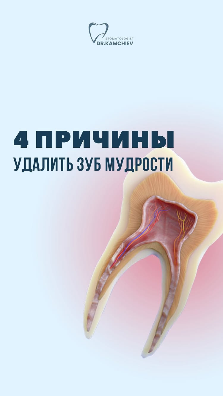 Удаление зубов мудрости